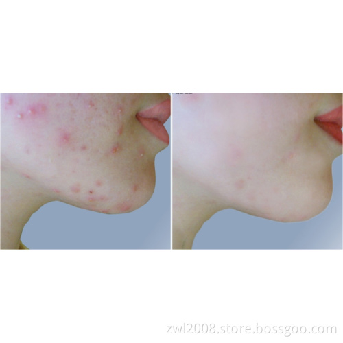 Sptf+ - Advanced IPL (FDA Approved)